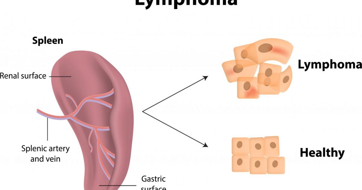 10 Lymphoma Facts To Know The Difference