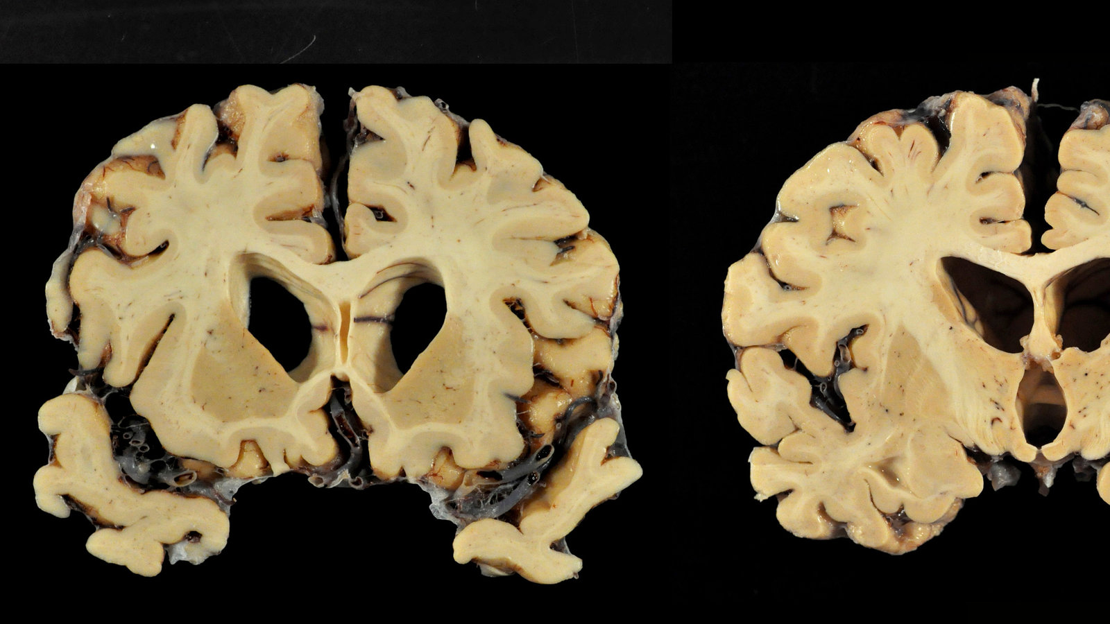 Aaron Hernandez Cte