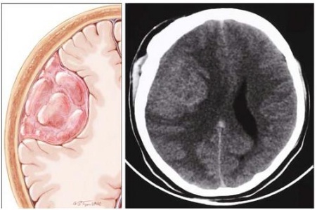 About Ct Scanner And Ultrasound Brain Tumor Ct Scan Examination Techniques