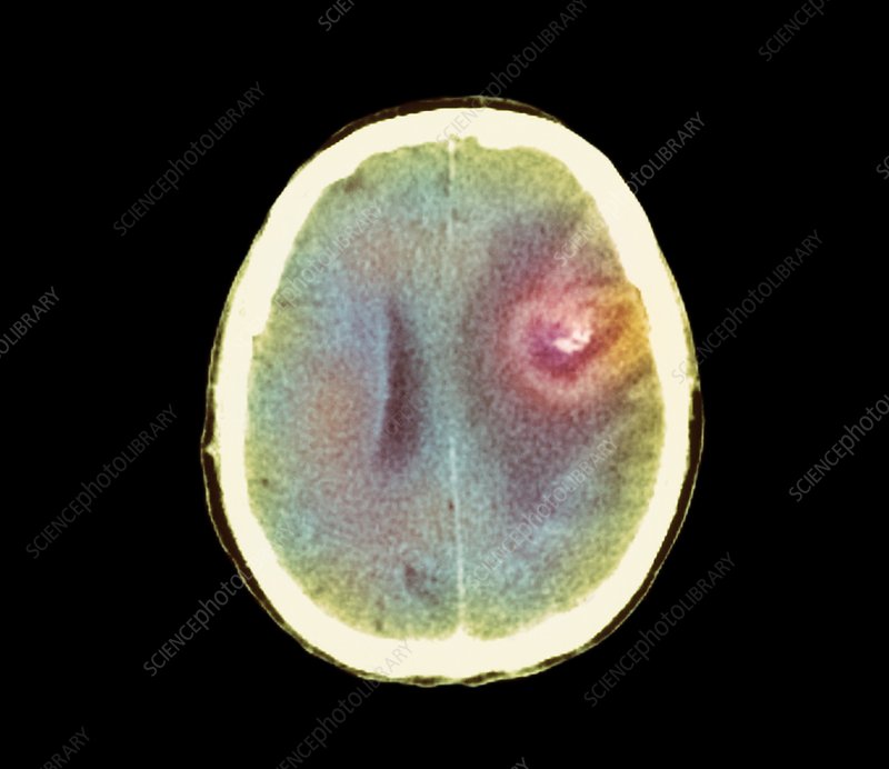 Astrocytoma Brain Cancer Ct Scan Photograph By