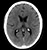 Ct Brain Scroll Image Gallery Cerebral Metastases